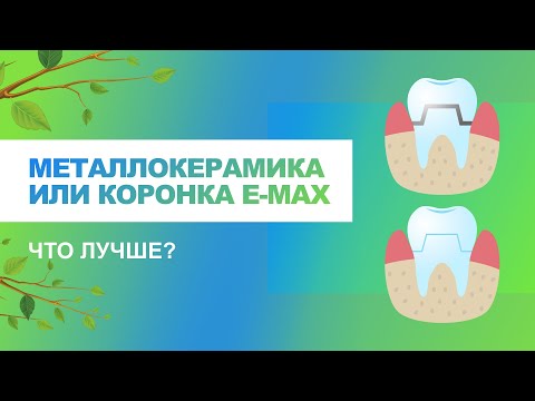 📌 Металлокерамика или коронка e-max, какие материалы лучше?