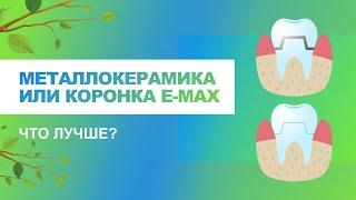 📌 Металлокерамика или коронка e-max, какие материалы лучше?