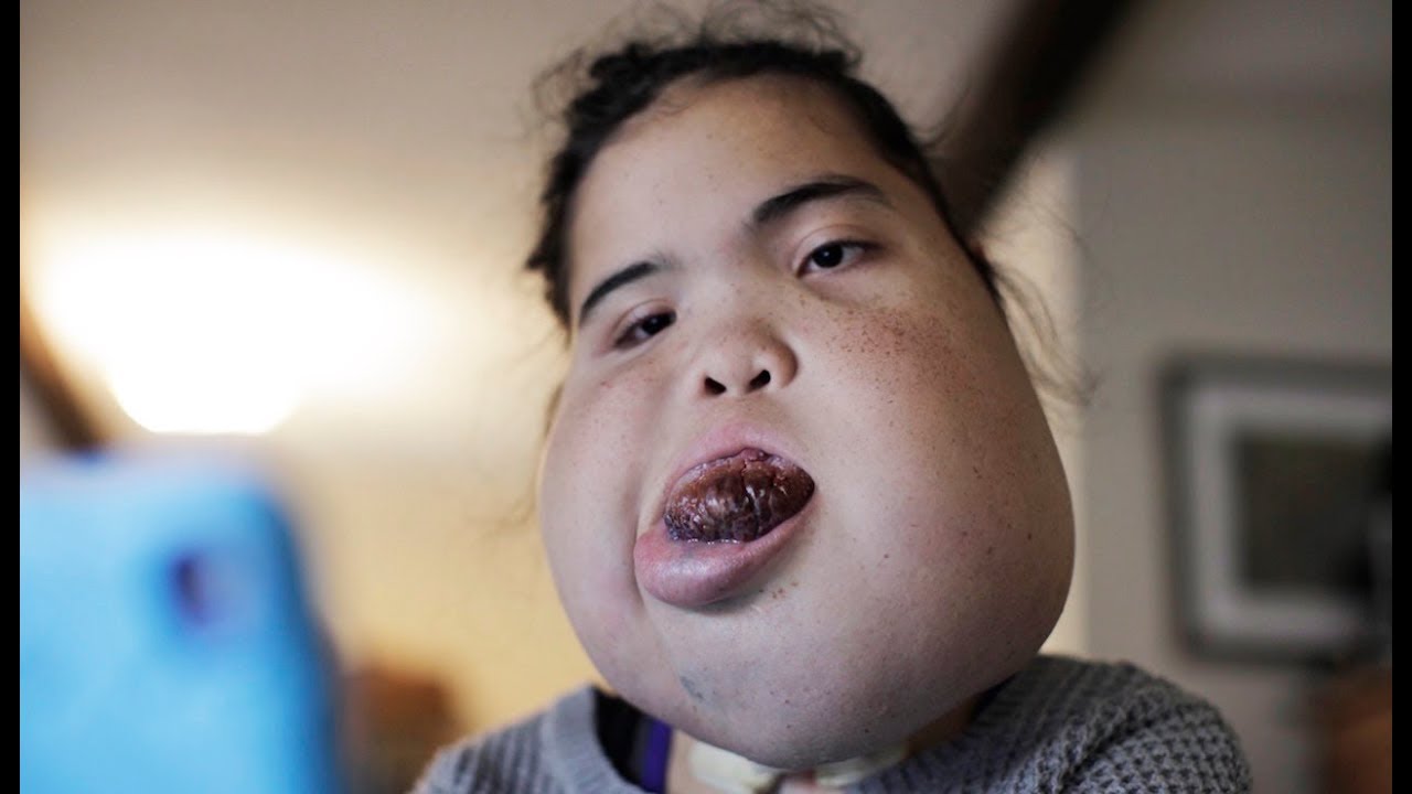 Teenager With Facial Tumour Proves Doctors Wrong | BORN DIFFERENT