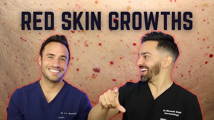 Cherry Angiomas and How to Treat Them | Doctorly D...