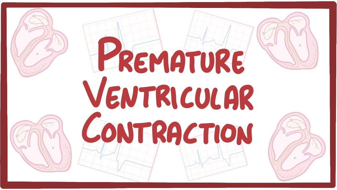 Premature Ventricular Contraction - causes, symptoms, diagnosis ...