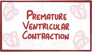 Premature Ventricular Contraction  causes, symptoms, diagnosis, treatment, pathology