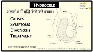 What is Hydrocele | hydrocele Ka upchar and bachav | exercise & medicine for hydrocele in Hindi.