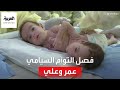 التاسعة هذا المساء إجراء جراحة فصل التوأم السيامي العراقي عمر وعلي بعد شهرين 