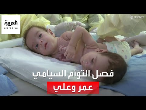 التاسعة هذا المساء إجراء جراحة فصل التوأم السيامي العراقي عمر وعلي بعد شهرين