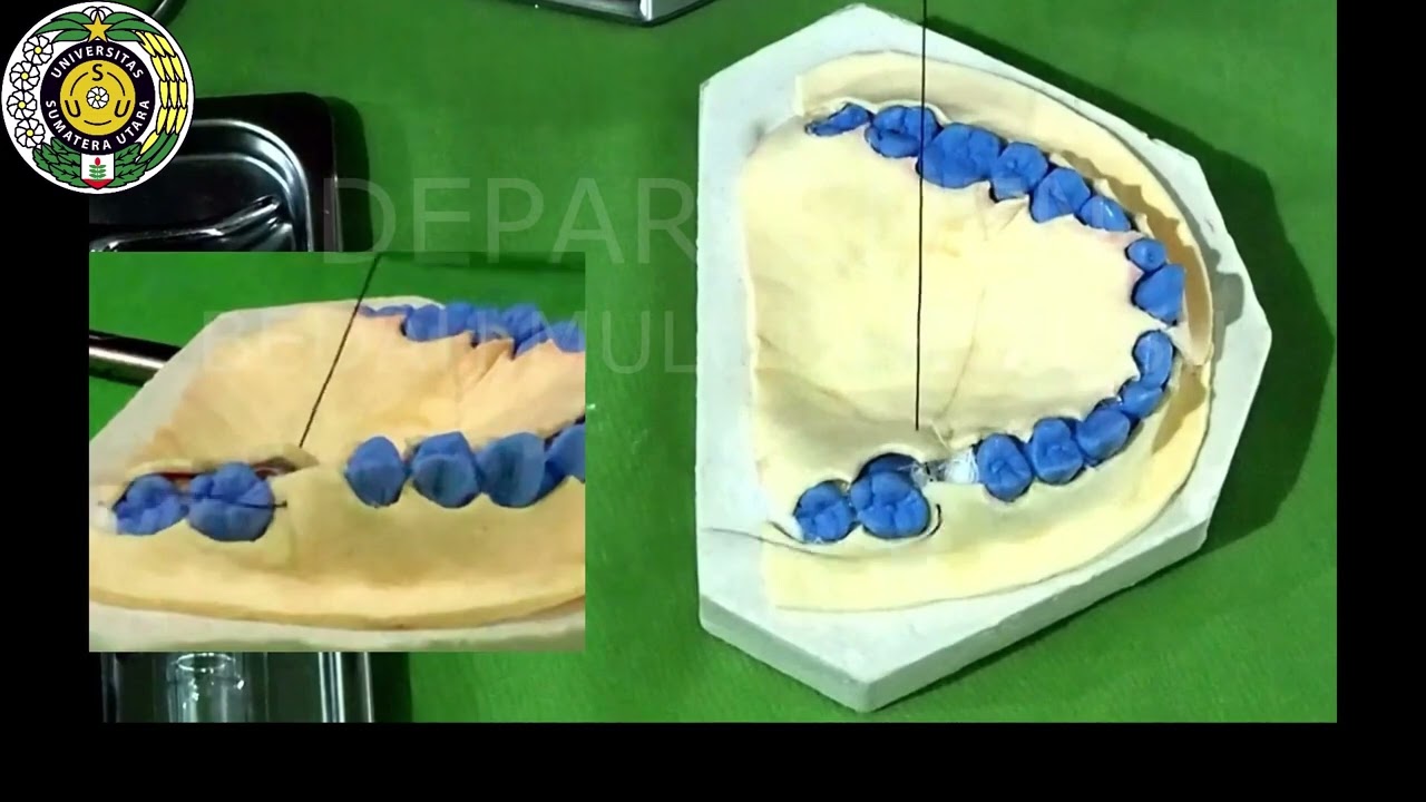 Video Pembelajaran Teknik Penjahitan dan Tatalaksana Oroantral Communication