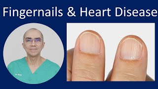 Fingernails in Heart Disease
