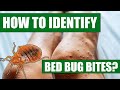 How To Identify Bed Bug Bites - Can Doctors or Exterminators Identify Bed Bug Bites?