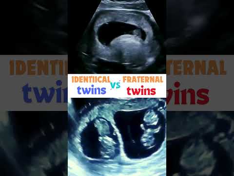 Identical v Fraternal