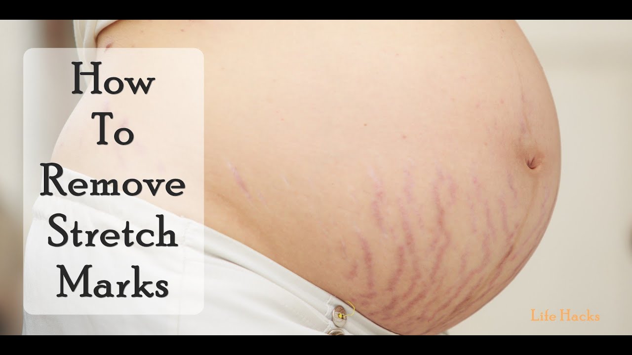 How To Remove Stretch Marks त्वचा से 'प्रेगनेंसी' या 'मोटापे' के