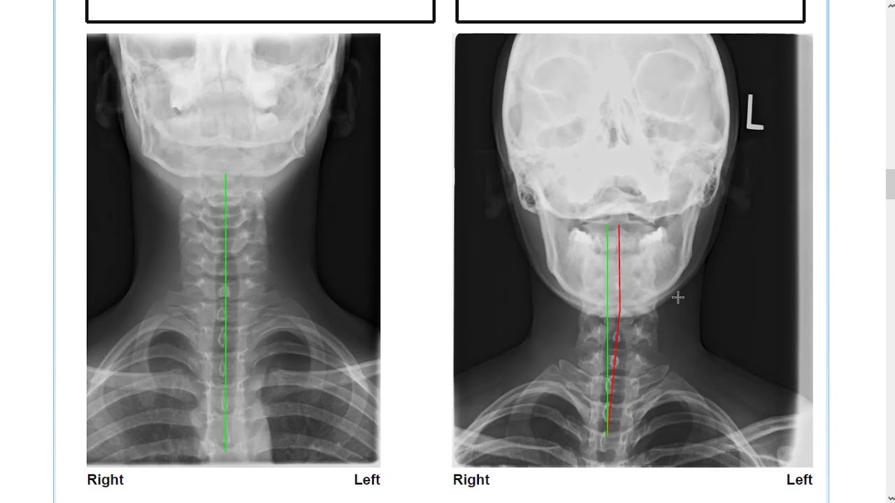 Is Your Spine Out Of Alignment?
