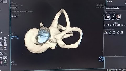 CT cochlea processing