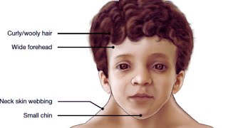 What is Noonan Syndrome? Symptoms, Treatment, Causes, Prognosis
