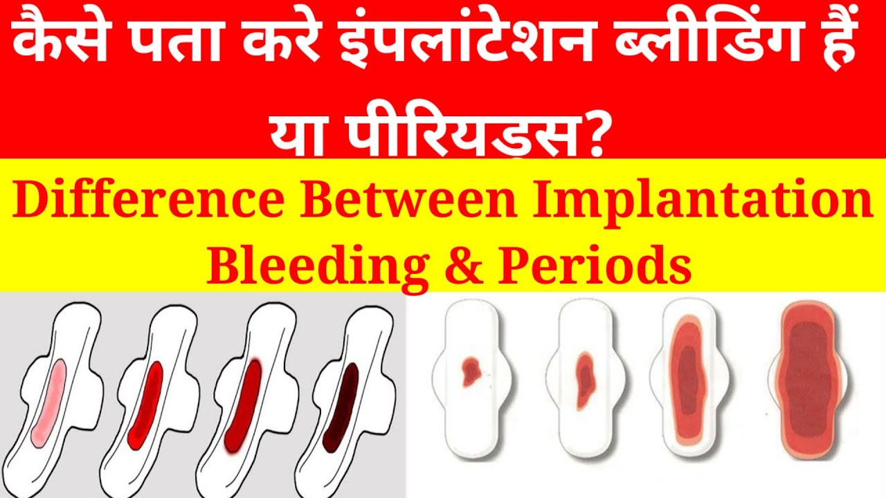 Iimplantation Bleeding Vs Period इंप्लांटेशन ब्लीडिंग And पीरियड Implantation Bleeding In