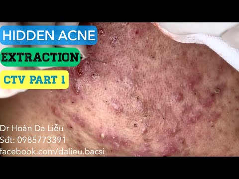 Nặn mụn nhọt mủ, mụn áp xe, mụn ẩn ở mặt| Squeeze super big pimples on the face 0985773391 part 1ctv
