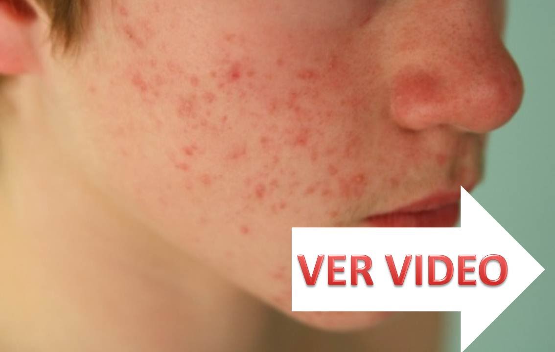 remedios naturales para la artritis ☞ Como tratar la eczema, la psoriasis y la dermatitis con aloe vera