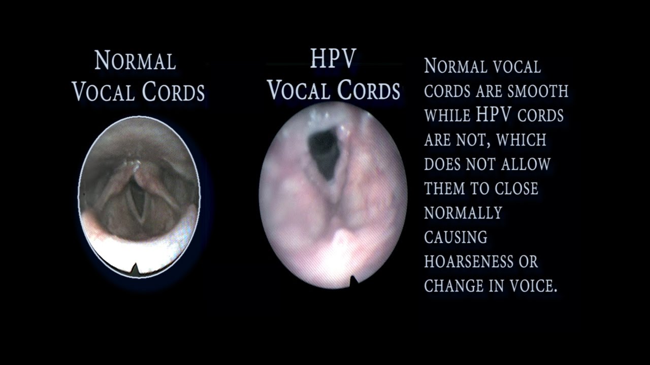 Treatment of vocal cords Treatment of vocal cords