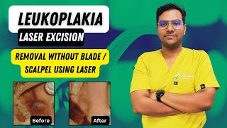 Dr Rudra Mohan | Leukoplakia Removal with the Help of Soft Tissue Laser | No need for Blade/Scalpel screenshot 1