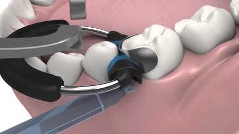 Composi Tight® 3D XR Sectional Matrix System