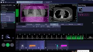 How to scan coronary arteries on SIEMENS go.Top & ALL  تصوير شرايين القلب بواسطه جهاز سيمنس جو توب