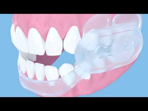 SleepRight Dura-Comfort Dental Guard Features