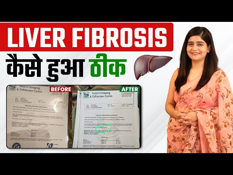 लिवर Fibrosis कैसे होगा ठीक | Reverse Liver Fibrosis Reduce KPA (25.7 to 13.3) | SRIAAS