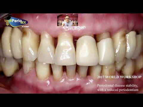 Vídeo: Cartografía Dental Y Periodontal: Propósito Y Procedimiento