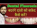DENTAL FLUOROSIS TREATMENT WITH COST