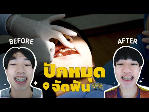 Ep3 : ภูมิศักดิ์ไปปักหมุดจัดฟัน | จัดฟันแบบดามอน | damon system | 101 Smile Dental Clinic