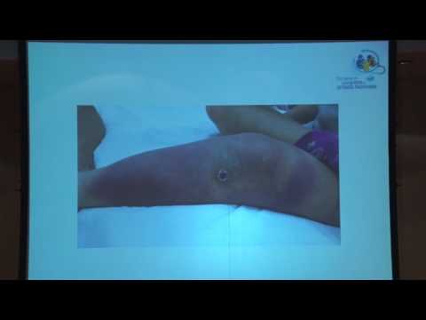 Actualización en infecciones bacterianas de la piel – Dra. Rosa Marina Flores