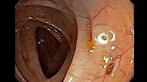 ¿Puede una endoscopia detectar la diverticulitis?