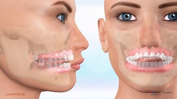 Myofunctional Therapy for Open Bite Correction Class II Carriere Motion 3D finished with SLXBrackets