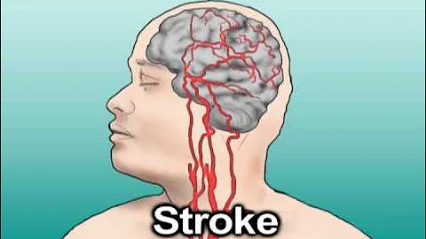Hypertension and Stroke (Health Tip)