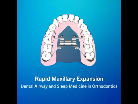 Rapid Maxillary Expansion | Airway and Sleep Group