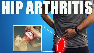 HIP OSTEOARTHRITIS. BEST Exercises, Stretches & Advice for Hip & Groin Pain Relief