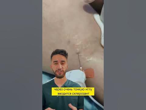 склеротерапия - YouTube