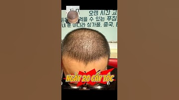 Kinh nghiệm cấy tóc dhi ngày 20 chữa hói đầu rụng tóc #caytoc #caytoctuthan #caytocdhi