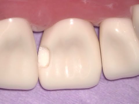 #8ML Composite Preparation