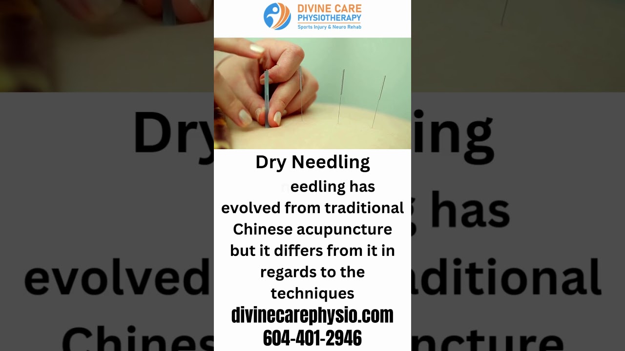 Dry Needling Treatment | Divinecare Physiotherapy Langley BC 