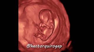 3D ultrasound at 11 weeks of pregnancy