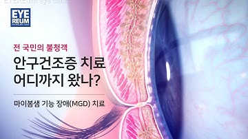 [아이리움안과] IPL 레이저를 이용한 마이봄샘 기능 장애(MGD) 치료