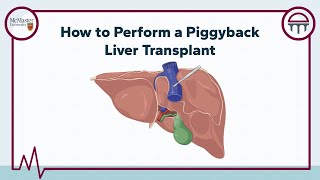 How to Perform a Piggyback Liver Transplant by Demystifying Medicine McMaster 1,136 views 2 months ago 10 minutes, 48 seconds