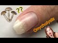 I Got ONYCHOLYSIS  &  My Nail is LIFTING OFF !   ( Nail Injury )