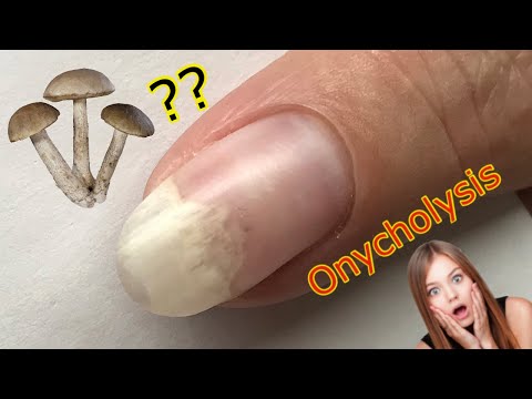 วีดีโอ: วิธีการรักษา Onycholysis