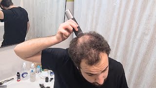 BALDING In My 20's - Shaving My Head & Accepting Going Bald