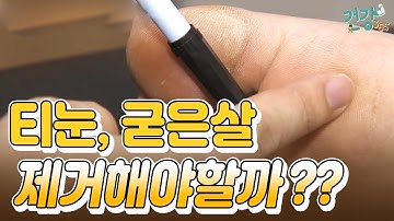 티눈과 굳은살, 꼭 제거해야 할까?? / YTN 라이프