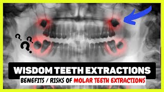 Wisdom Teeth Extraction Procedure | Removal Cost, Pain, Dry Socket