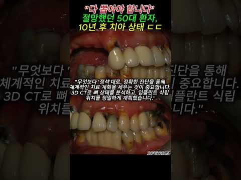 "다 뽑아야 합니다" 절망했던 50대 환자, 10년 후 치아 상태 ㄷㄷ