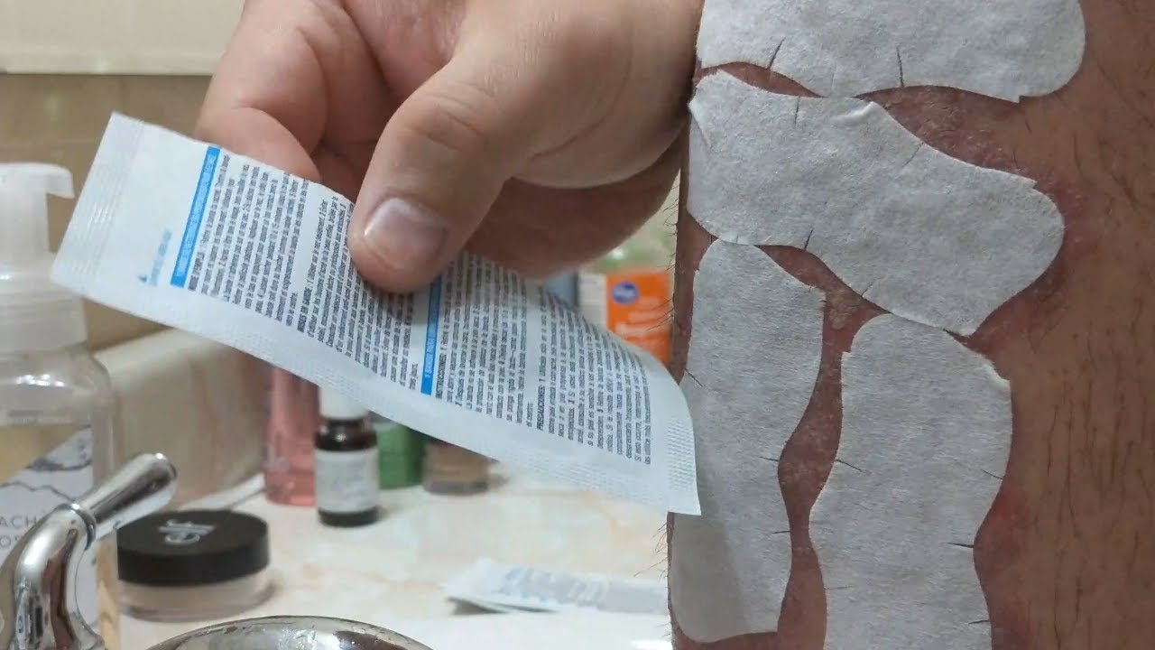 BIORE STRIPS vs PSORIASIS FLAKES YouTube