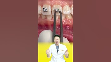 Đây là cách để mắc cài gắn vào răng #nhakhoa #bacsidieutaithu #niengrang #shorts